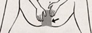 An oral dam is placed on the genitals (or any place on the body!) to reduce the risk of STI transmission during oral sex.
